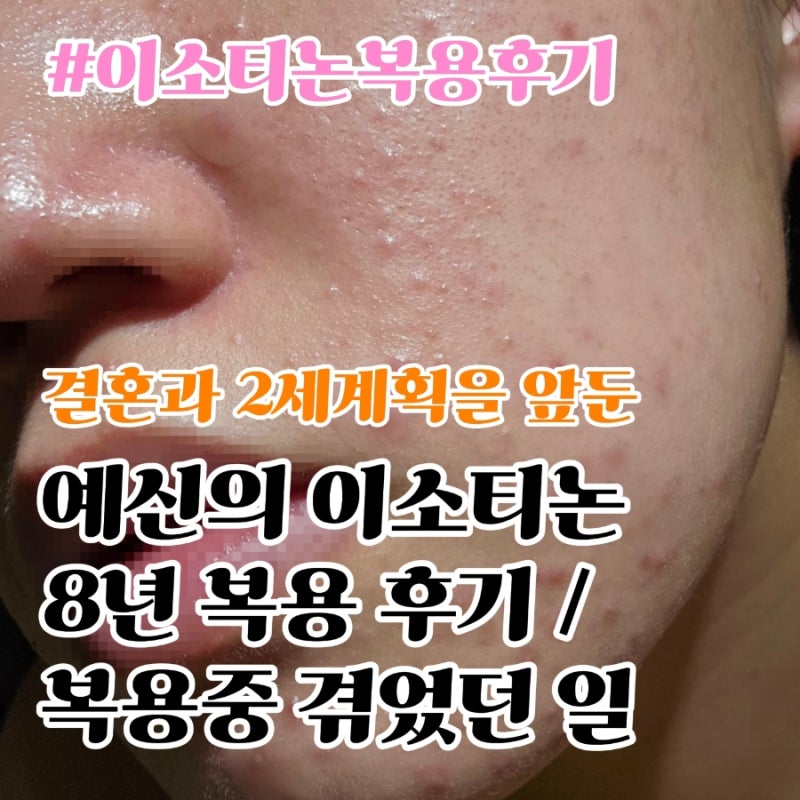 결혼과 2세계획을 앞둔 예신의 이소티논 8년 이상 복용 후기 / 효과, 부작용, 복용 방법 복용....