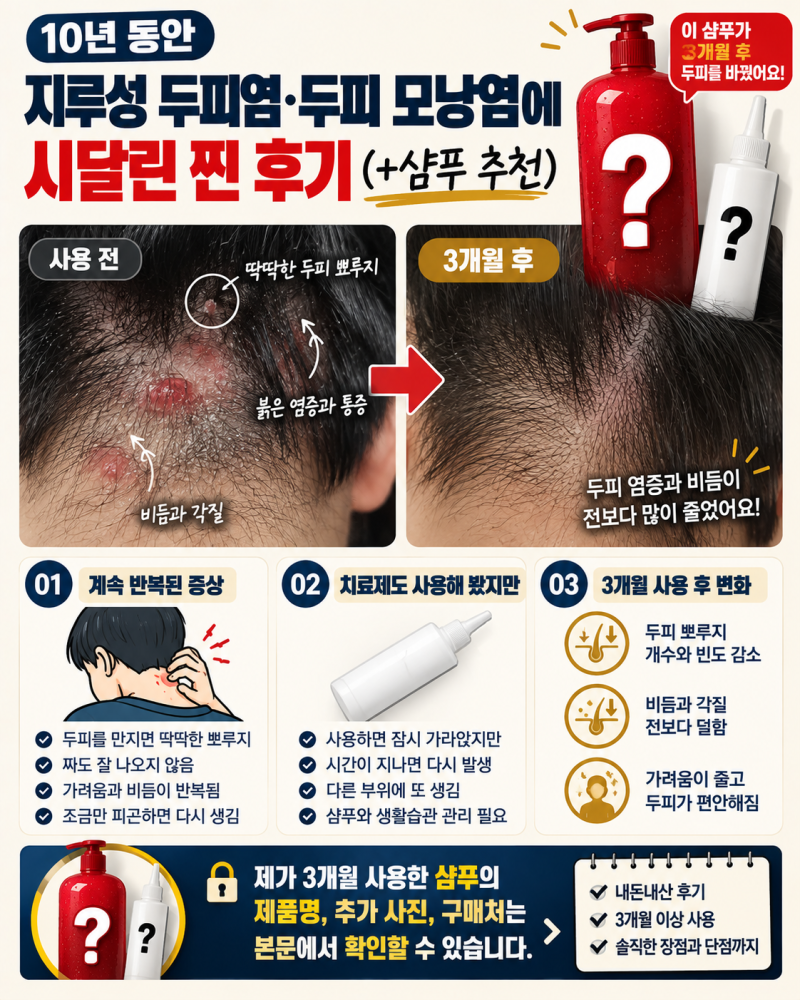 10년 동안 지루성 두피염·두피 모낭염에 시달린 찐 후기 (+샴푸 추천)