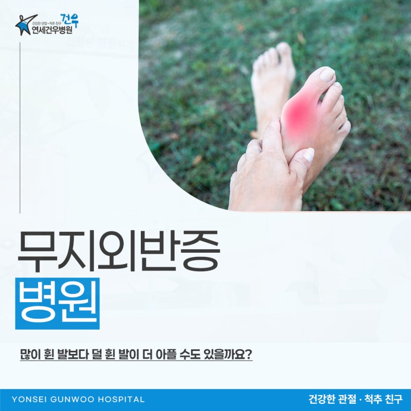 무지외반증 병원 많이 휜 발보다 덜 휜 발이 더 아플 수도 있을까요?