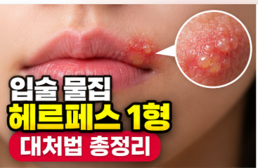 입술 물집 헤르페스 1형 원인 아시클로버 티로트리신 연고 바르는 골든타임 총정리