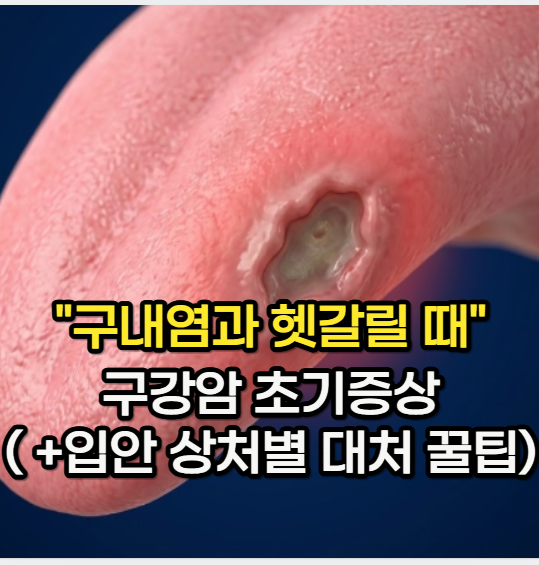 구강암 초기 증상 "구내염과 헷갈릴 때 구별하는" 혀암 증상 (+설암)