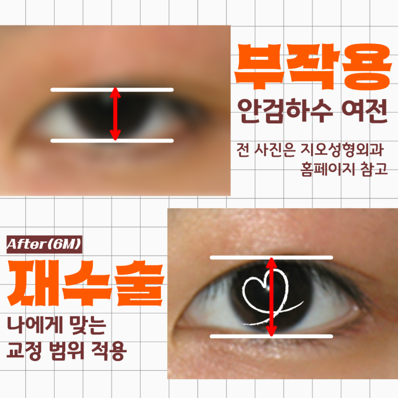 안검하수 부작용 원인 해결 재수술 해준 지오성형외과