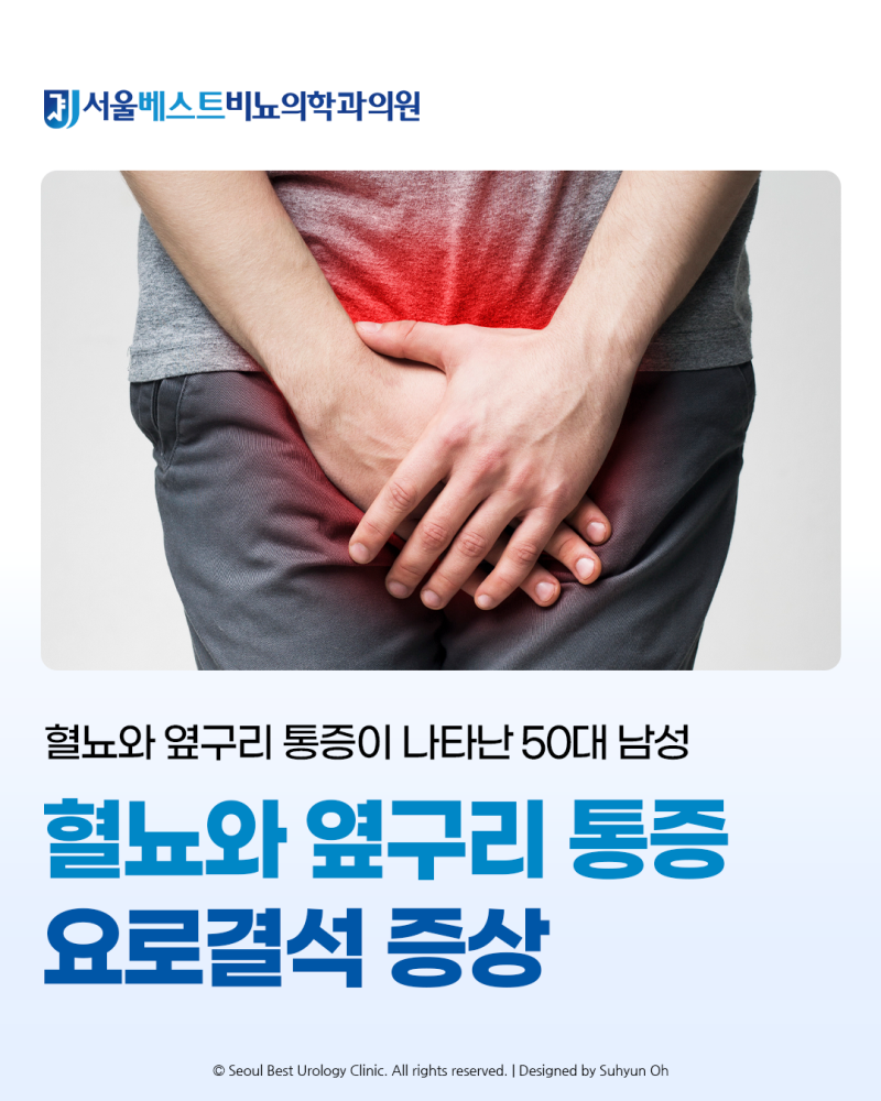 요로결석 증상, 혈뇨와 옆구리 통증이 나타난 50대 남성 | 서울베스트비뇨의학과