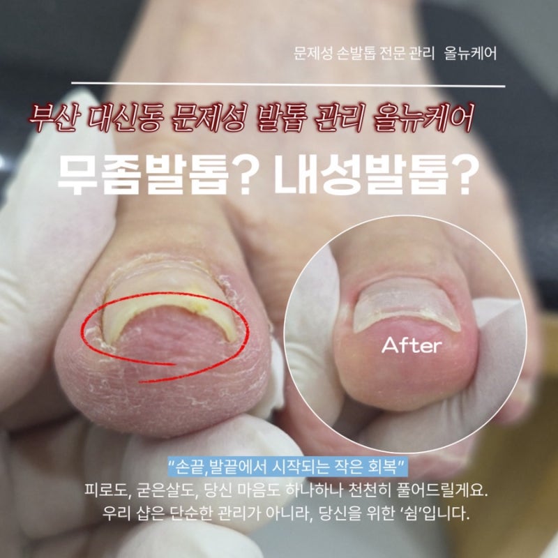 부산 서대신동 내성발톱 교정 올뉴케어 ㅣ무좀으로 두꺼워지고 아픈 발톱