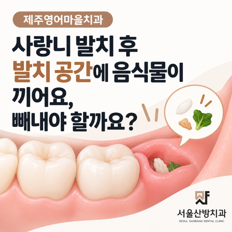 제주영어마을치과 사랑니 발치 후 발치 공간에 음식물이 끼어요, 빼내야 할까요?