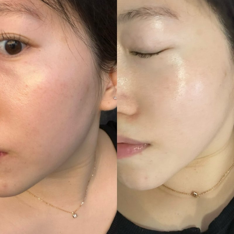 고우리 스킨부스터 다운타임 통증은 어떨까?