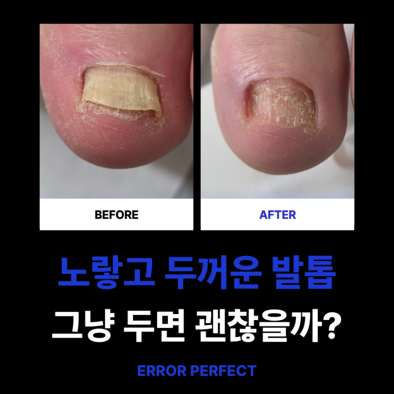 강남 무좀발톱 - 발톱이 노랗고 두꺼워졌다면? 그냥 두면 괜찮아질까요?