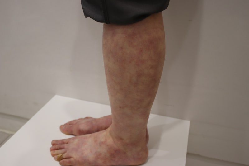 다리자반증, 붉은 점인 줄 알았는데 상처가 생기기 시작했다면?
