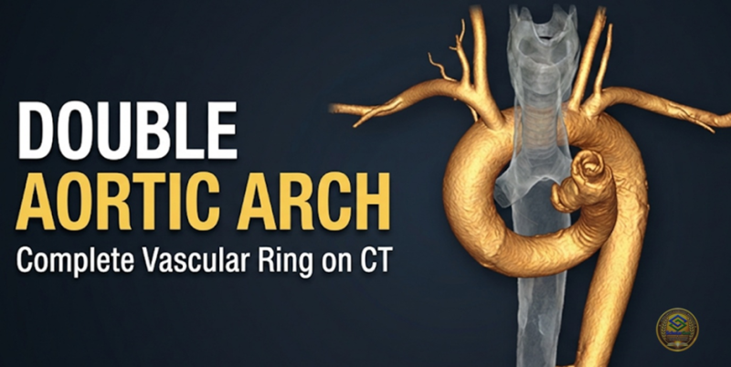 Case Study_1079-가슴 통증을 호소하는 70대 남성-이중 대동맥궁(Double aortic arch)