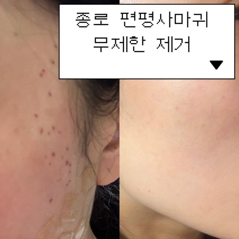 종로피부과 다빼자 편평사마귀 n백개 빼고온 후기