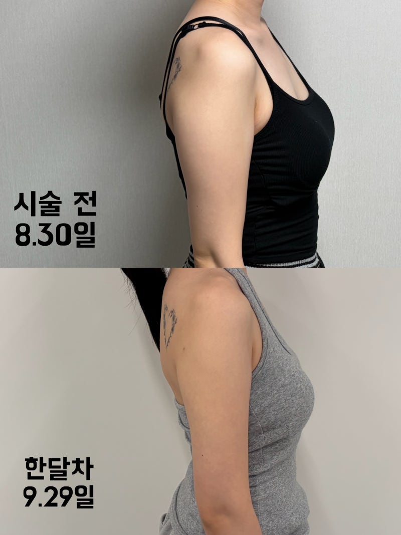 예비신부 팔뚝 관리｜부산 팔뚝지방추출주사 한달차(생생후기 자세함,,)