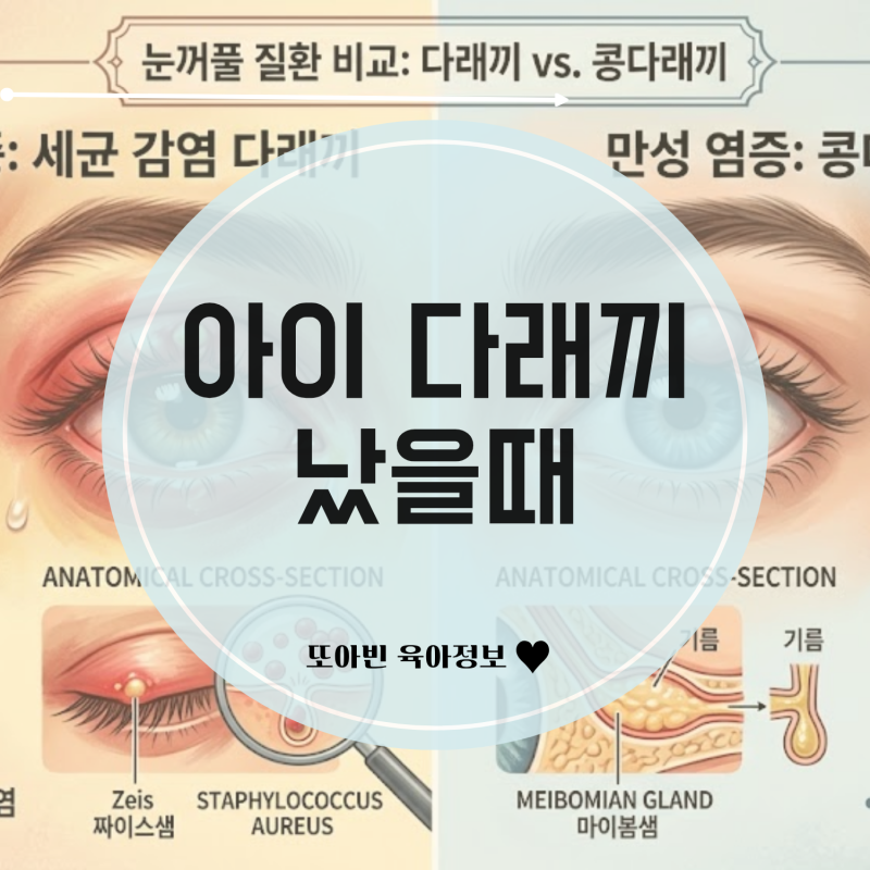 아이 다래끼 먹는약부터 안약까지 집에서 관리하는 방법