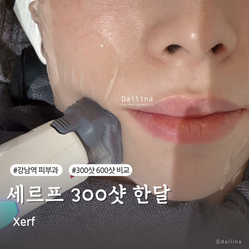 세르프 리프팅 300샷 효과 후기 강남역 피부과 가격 정보
