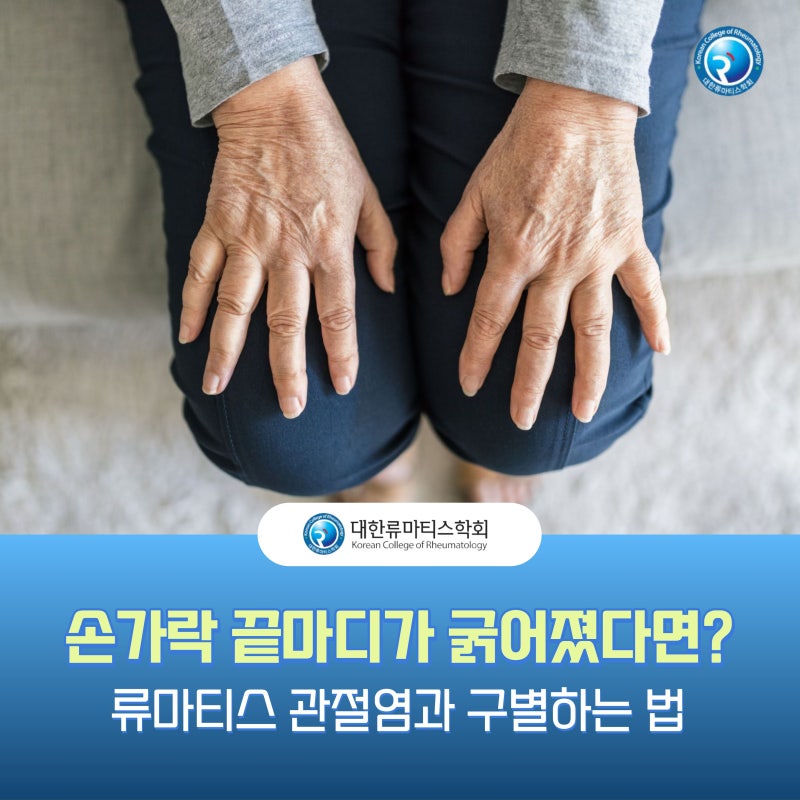 손가락 끝마디가 굵어졌다면? 류마티스 관절염과 구별하는 법