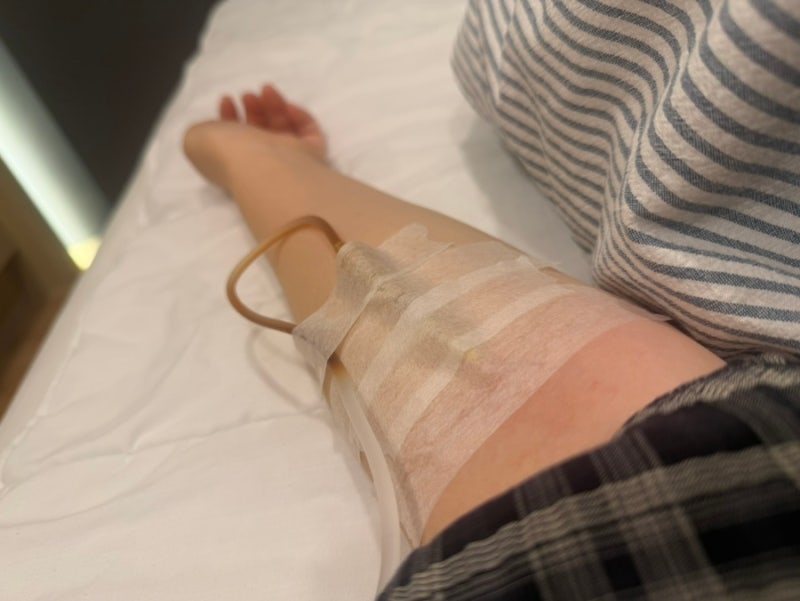 수면다원검사 결과｜무호흡은 없었지만 주기성 사지운동 진단, 철분 치료 시작