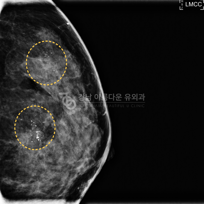 유방 미세석회화 치료 필요할까? 조직검사 먼저!