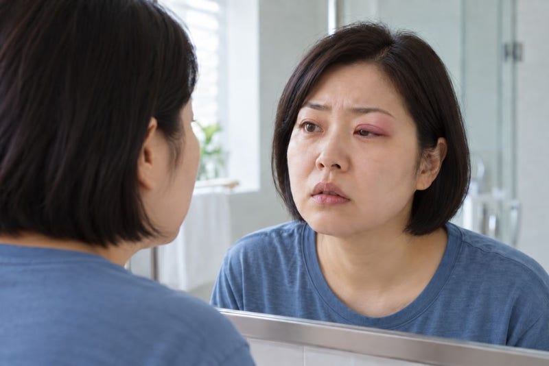 다래끼 초기증상, 고름 없이 붓기만 해도? 가족에게 옮나요?
