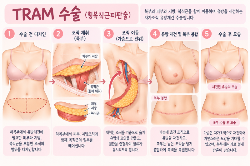 [심사간호사] 유방암 환자의 유방재건술 종류 ｜DTI, 조직확장기 삽입술, DIEP,TRAM, LD flap 등