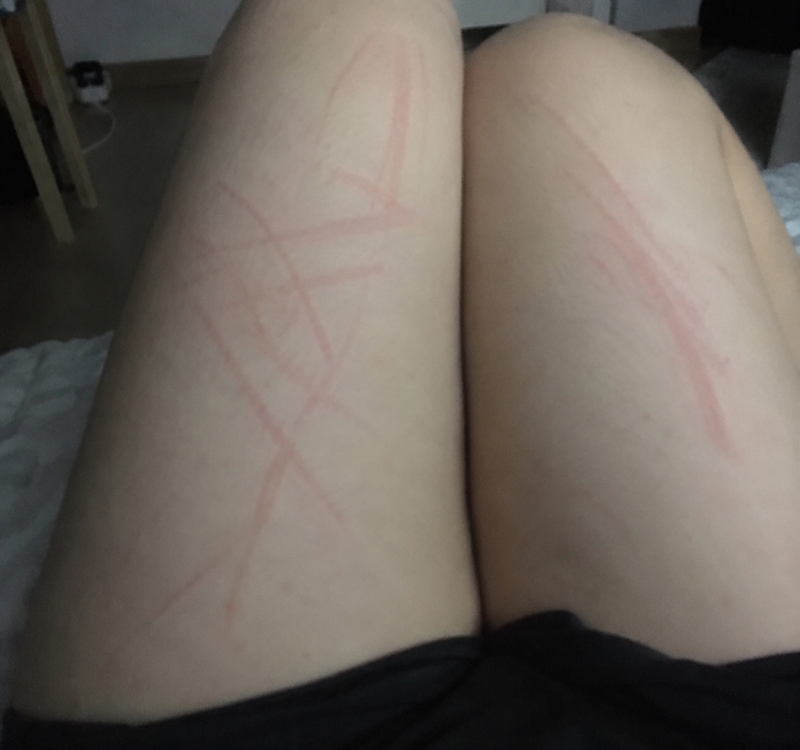 피부묘기증 가려움 왜 생길까? 2개월 관리해본 후기