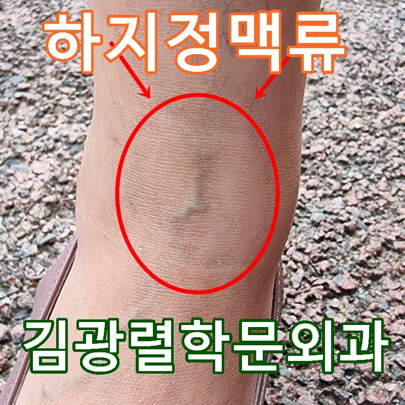 하지정맥류와 운동 통증, 구미시 걷기대회 전후 주의사항 심할 경우 병원 진료 추천