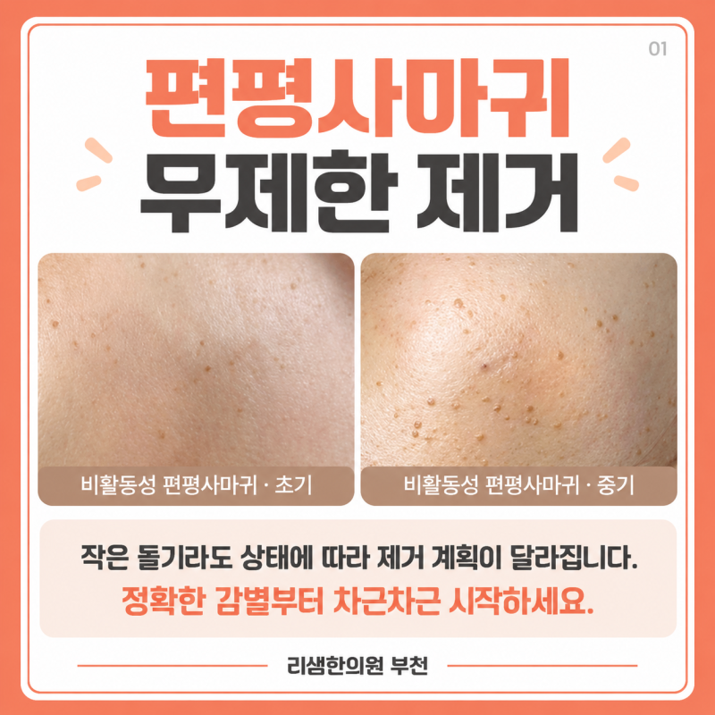 부천 상동역 편평사마귀 무제한 제거 성지