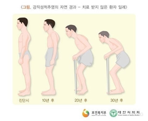 18년을 함깨한 강직성 척추염.