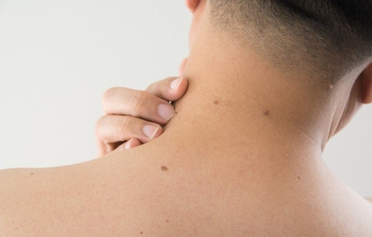 편평사마귀 치료, 한 번에 끝날까요? 남양주 다산신도시 피부과가 알려드립니다