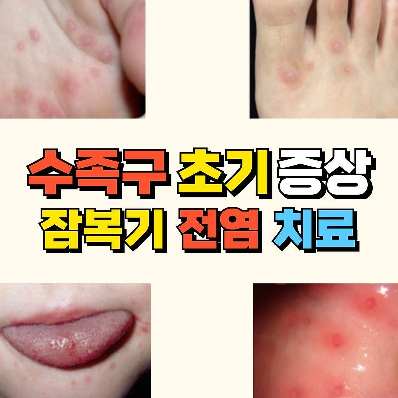 요즘 유행하는 수족구병, 증상부터 예방까지 한눈에!
