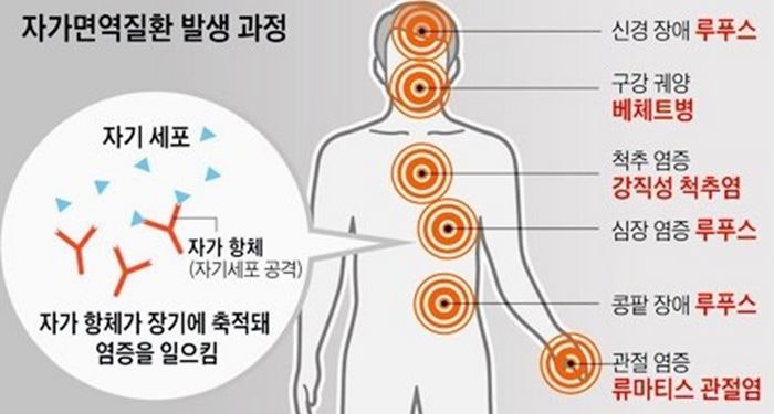자가면역질환 루푸스(SLE)란? 원인, 치료(처방) 및 예후 완벽 정리