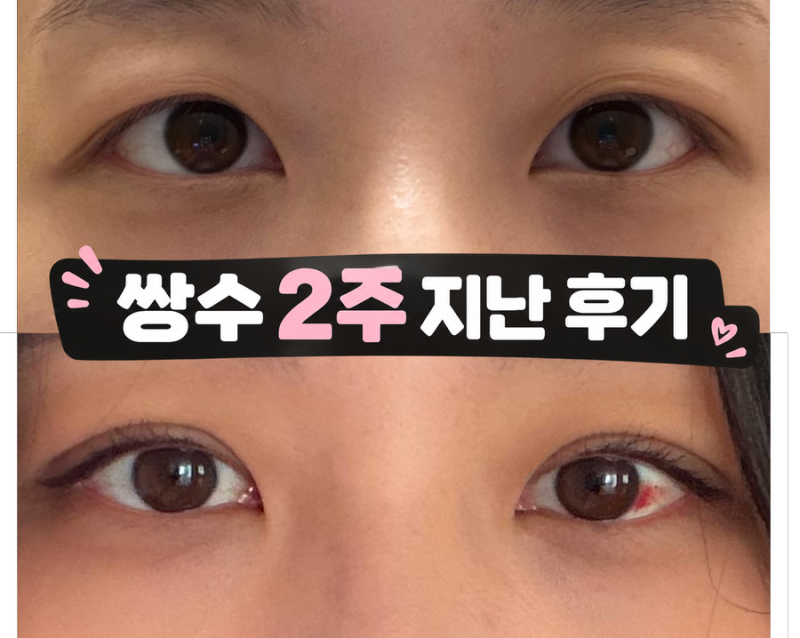 쌍꺼풀 수술 2주 솔직 후기｜안검하수 눈매교정, 붓기·멍·눈에 피 결막하출혈 회복 기간까....