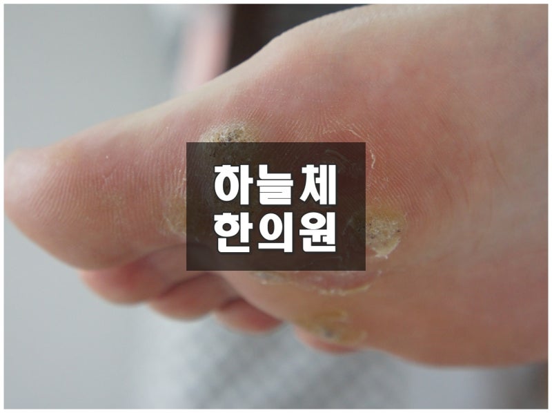 창원발바닥사마귀, 티눈과 비슷해 보여도 원인이 다릅니다