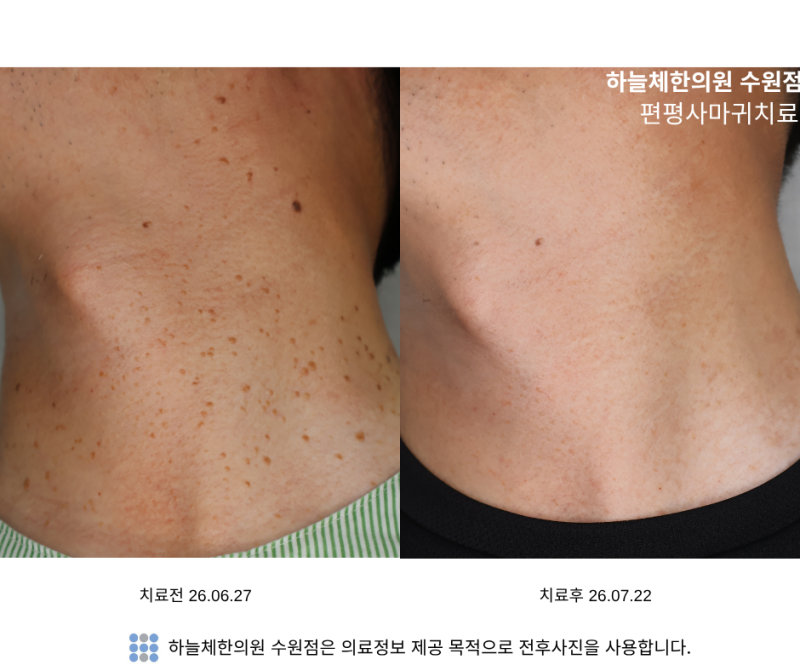 편평사마귀 치료 후 딱지 관리는 어떻게 해야할까요?