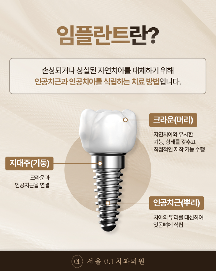 오금동치과 임플란트 후 식사는 언제부터, 어떤 음식을 먹어야 하나요?