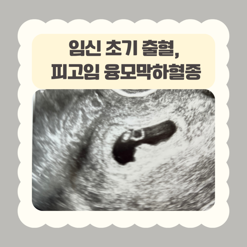 융모막하혈종 피고임 임신 초기 6주차 갈색혈 후기, 폴립 출혈 진단후 변화