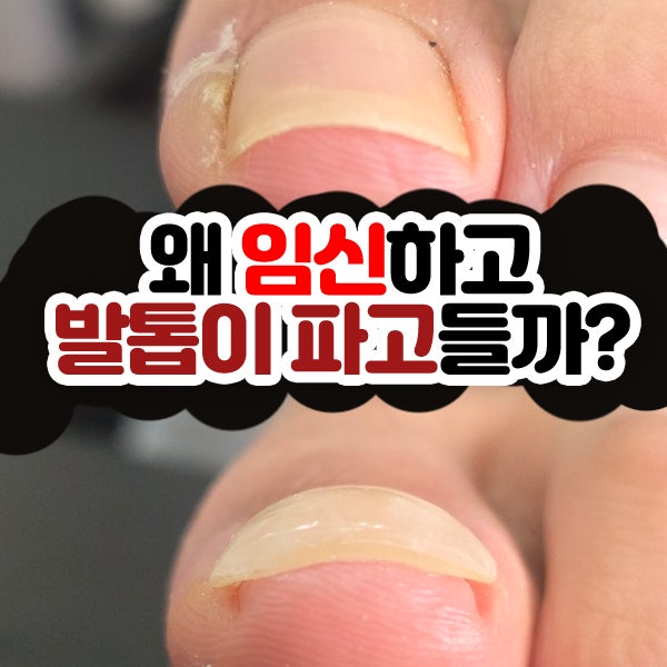 임신 중 악화되기 쉬운 임산부 내성발톱·발톱무좀 어떻게 관리해야 안전할까?