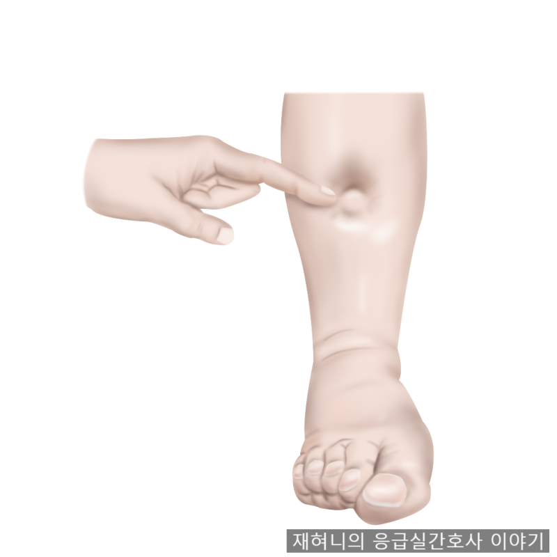 소아 신증후군 증상, 팔다리가 붓는 부종부터 단백뇨와 치료까지