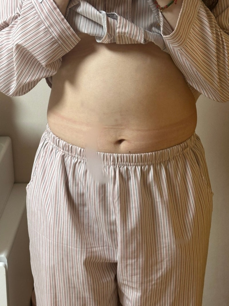 마운자로 종로 성지ㅣ정상체중 마운자로 , 다이어트 -10kg