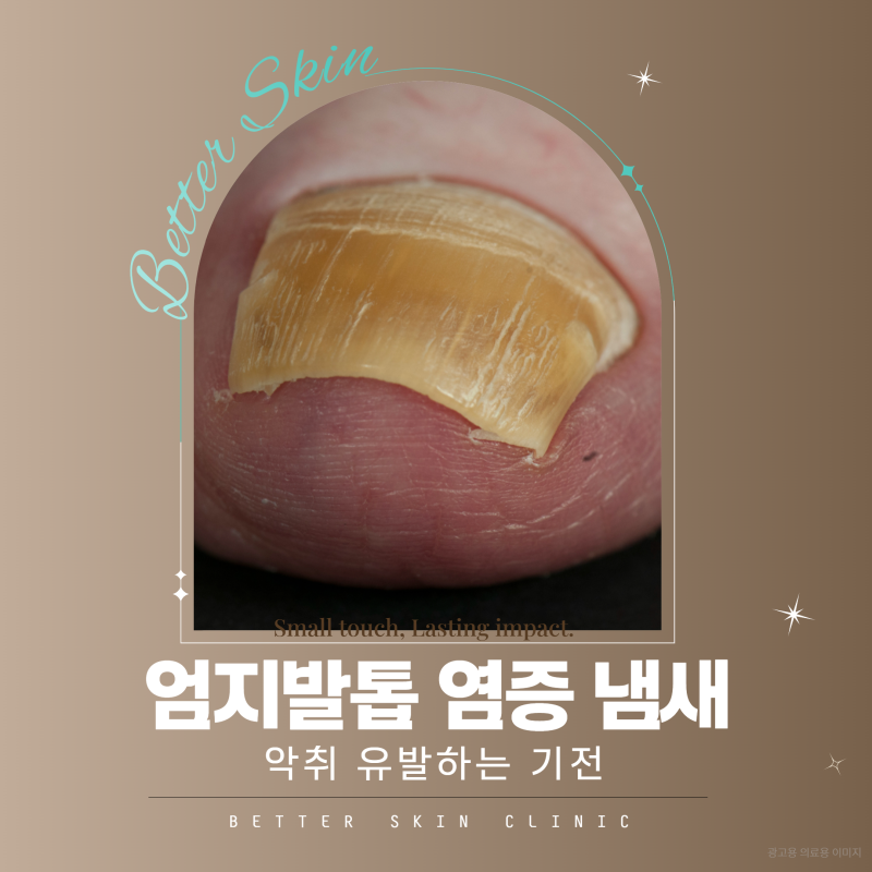 엄지발톱 염증 냄새 유발하는 기전