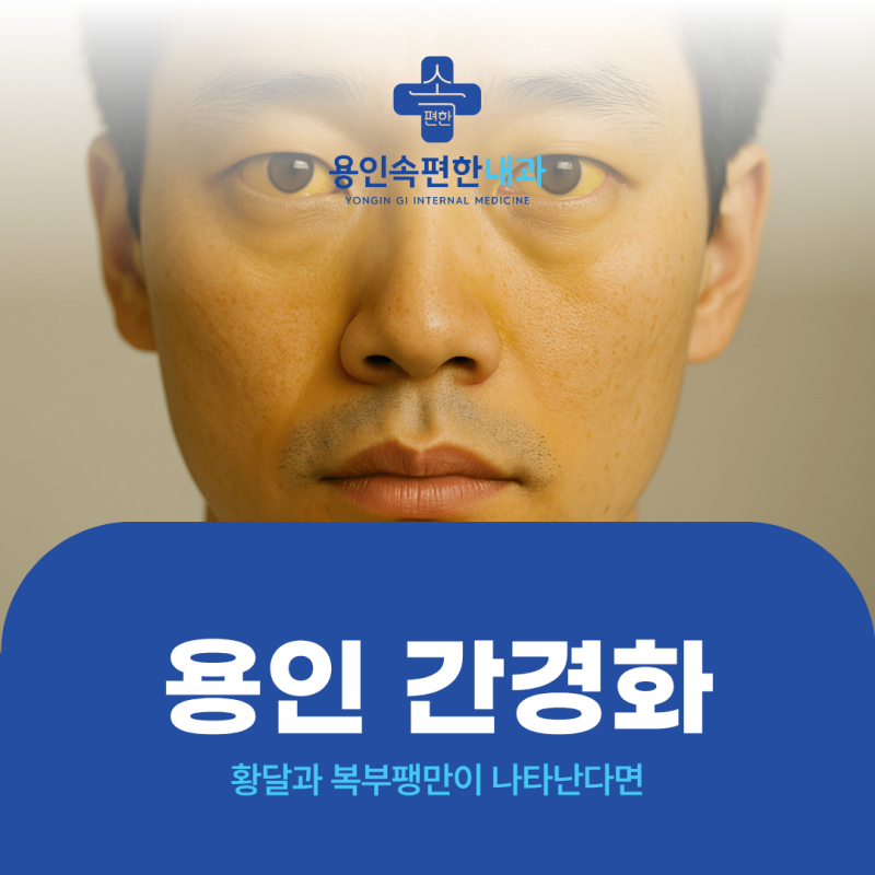 용인 간경화, 황달과 복부팽만이 나타난다면