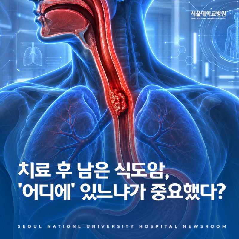 식도암 치료 후 남은 암, 위치마다 달랐다… 서울대학교병원 '공간 지도' 연구