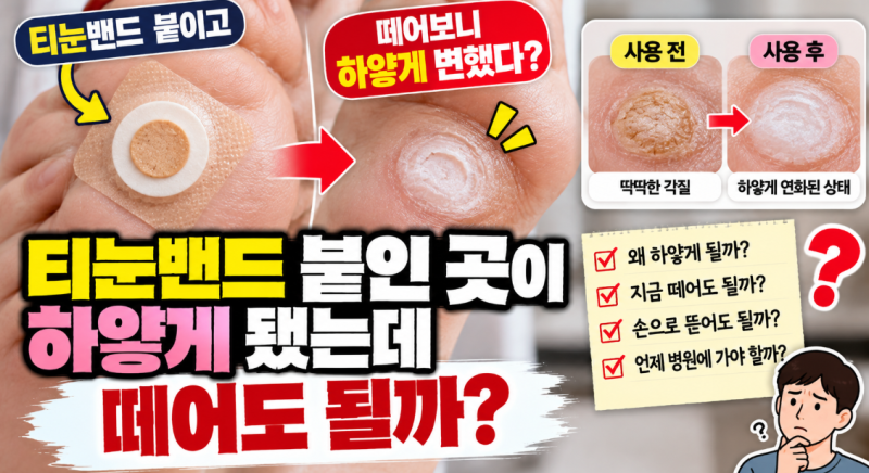 티눈밴드 붙인 곳이 하얗게 됐는데 떼어도 될까?