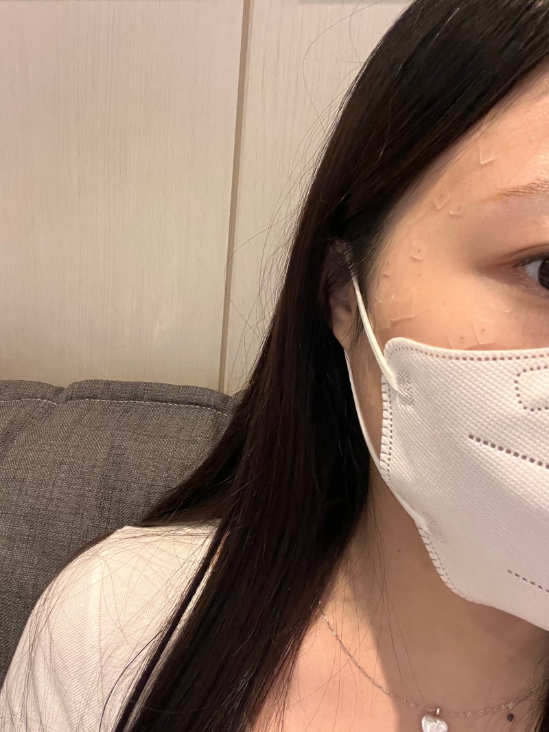 서울/경기 편평사마귀 10만원대 무제한 내돈내산 후기 | 리터치1회 무료·예약 바로 가능한 곳