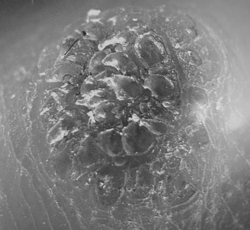 발바닥사마귀, 제거하지 않아도 사라지나요? 자연스럽게 탈락하는 원인 치료
