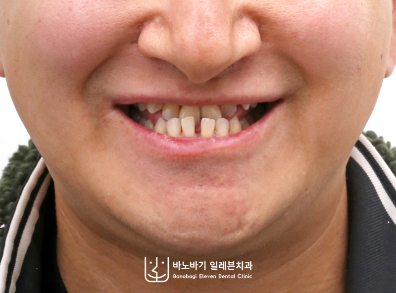 주걱턱 교정, 비수술로 얼마나 개선될까요? (논문으로 알아보았습니다)