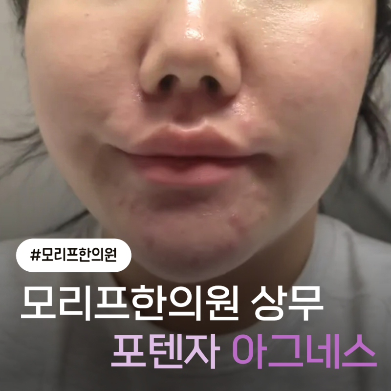 모리프한의원 상무점 · 포텐자 아그네스 & 아쿠아필 첫 시술 후기