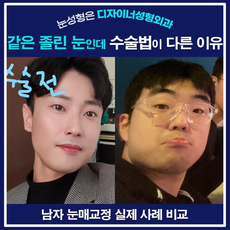 남자 눈매교정, 왜 누구는 비절개·누구는 절개일까요? 남자 안검하수 사례 비교