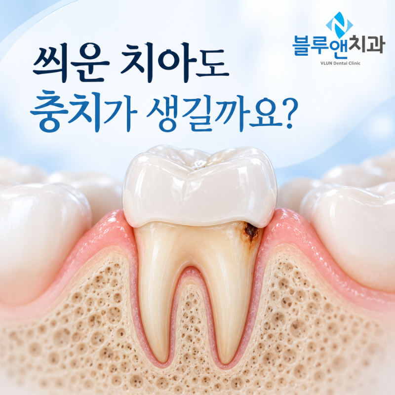 크라운을 씌운 치아도 충치가 생길까요?