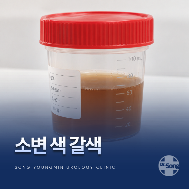 소변 색 갈색, 혈뇨 원인과 병원에 가야 하는 기준