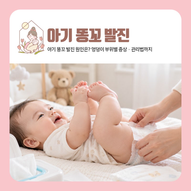 아기 똥꼬 발진 원인은? 아기 똥꼬 발진 연고부터 엉덩이 부위별 증상·관리법까지