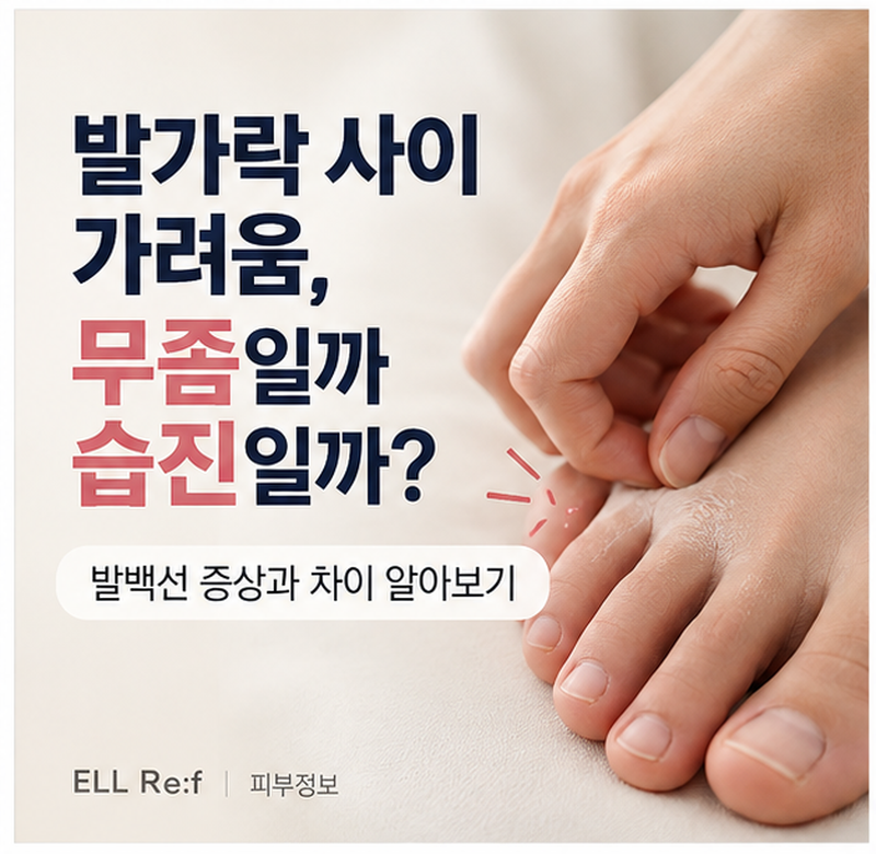 발가락 사이 가려움, 무좀일까 습진일까? 발백선 증상과 차이